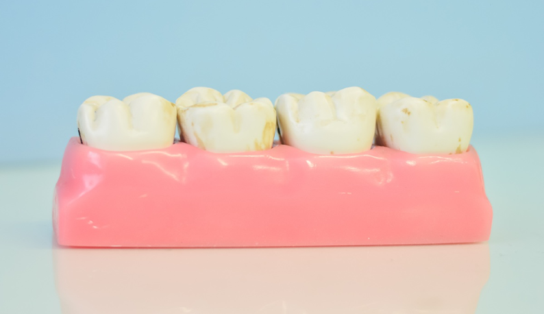 Imagem de uma prótese dentária com dentes danificados