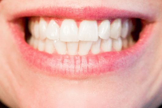 Imagem: foto de uma boca sorrindo a apresentando os dentes
