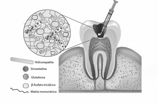Imagem: ilustração do dente e da gengiva, mostrando a aplicação da resina com seringa e as substâncias presentes no produto