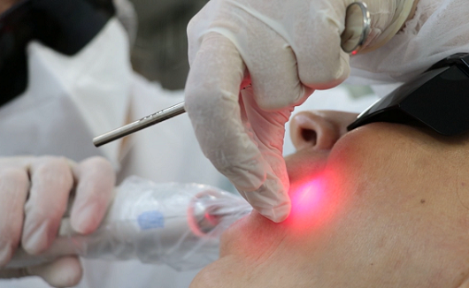 Aplicação de laser na parte interna da bochecha de paciente