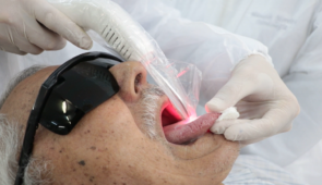 Paciente com a língua para fora e enfermeiro aplicando laser sobre ela