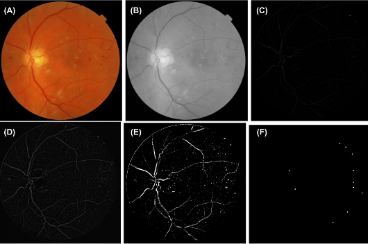 Seis imagens em sequência, com a primeira sendo uma retinografia original; as seguintes são a aplicação sistema VDRAN